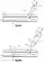 Fig. 12 - Vascular closure device