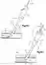 Fig. 13 - Vascular closure device