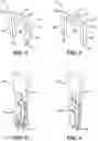 Fig. 02 - Orthopedic fixation system and method of use thereof