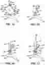 Fig. 07 - Orthopedic fixation system and method of use thereof