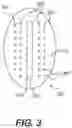 Fig. 04 - ABDOMINAL WALL TREATMENT DEVICES