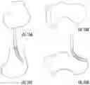 Fig. 13 - Steerable drill for minimally-invasive surgery