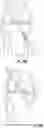 Fig. 16 - Steerable drill for minimally-invasive surgery