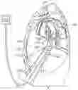 Fig. 01 - Diaphragm entry for posterior surgical access