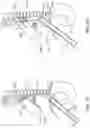 Fig. 03 - Diaphragm entry for posterior surgical access