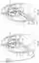 Fig. 04 - Diaphragm entry for posterior surgical access