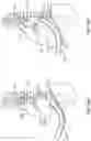 Fig. 29 - Diaphragm entry for posterior surgical access