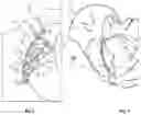 Fig. 03 - ACETABULAR COMPRESSION PLATE WITH DUAL CORTICAL FIXATION AND METHOD OF FIXING THEREOF