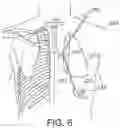Fig. 06 - Thoracoscopic methods for treatment of bronchial disease