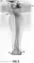 Fig. 07 - Intraoperative Systems and Methods for Determining and Providing for Display a Virtual Image Overlaid onto a Visual Image of a Bone