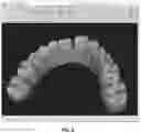 Fig. 09 - Dental arch width measurement tool