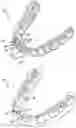 Fig. 01 - Methods for generating orthodontic models having bite adjustment structures