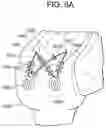 Fig. 13 - Tissue augmentation scaffolds for use in soft tissue fixation repair