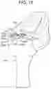 Fig. 23 - Tissue augmentation scaffolds for use in soft tissue fixation repair