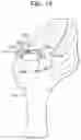 Fig. 24 - Tissue augmentation scaffolds for use in soft tissue fixation repair