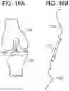 Fig. 30 - Tissue augmentation scaffolds for use in soft tissue fixation repair