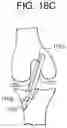 Fig. 31 - Tissue augmentation scaffolds for use in soft tissue fixation repair