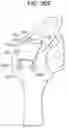 Fig. 58 - Tissue augmentation scaffolds for use in soft tissue fixation repair