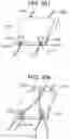 Fig. 60 - Tissue augmentation scaffolds for use in soft tissue fixation repair
