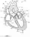 Fig. 03 - Method of Treating a Patient Using a Retrievable Transcatheter Prosthetic Heart Valve