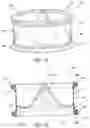 Fig. 08 - Method of Treating a Patient Using a Retrievable Transcatheter Prosthetic Heart Valve