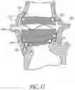 Fig. 18 - Method of Treating a Patient Using a Retrievable Transcatheter Prosthetic Heart Valve