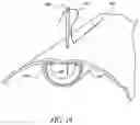 Fig. 21 - Method of Treating a Patient Using a Retrievable Transcatheter Prosthetic Heart Valve