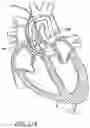 Fig. 29 - Method of Treating a Patient Using a Retrievable Transcatheter Prosthetic Heart Valve