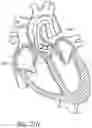 Fig. 30 - Method of Treating a Patient Using a Retrievable Transcatheter Prosthetic Heart Valve