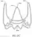 Fig. 36 - Method of Treating a Patient Using a Retrievable Transcatheter Prosthetic Heart Valve