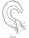 Fig. 43 - Method of Treating a Patient Using a Retrievable Transcatheter Prosthetic Heart Valve