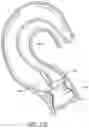Fig. 44 - Method of Treating a Patient Using a Retrievable Transcatheter Prosthetic Heart Valve
