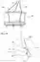 Fig. 69 - Method of Treating a Patient Using a Retrievable Transcatheter Prosthetic Heart Valve