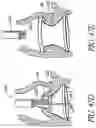 Fig. 73 - Method of Treating a Patient Using a Retrievable Transcatheter Prosthetic Heart Valve