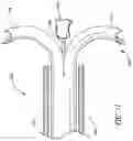 Fig. 77 - Method of Treating a Patient Using a Retrievable Transcatheter Prosthetic Heart Valve
