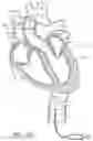 Fig. 78 - Method of Treating a Patient Using a Retrievable Transcatheter Prosthetic Heart Valve