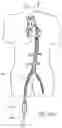 Fig. 86 - Method of Treating a Patient Using a Retrievable Transcatheter Prosthetic Heart Valve