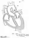 Fig. 87 - Method of Treating a Patient Using a Retrievable Transcatheter Prosthetic Heart Valve
