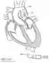 Fig. 88 - Method of Treating a Patient Using a Retrievable Transcatheter Prosthetic Heart Valve