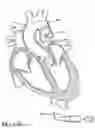 Fig. 89 - Method of Treating a Patient Using a Retrievable Transcatheter Prosthetic Heart Valve