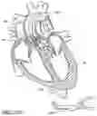 Fig. 90 - Method of Treating a Patient Using a Retrievable Transcatheter Prosthetic Heart Valve