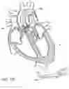 Fig. 91 - Method of Treating a Patient Using a Retrievable Transcatheter Prosthetic Heart Valve