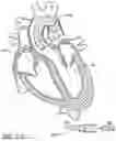 Fig. 93 - Method of Treating a Patient Using a Retrievable Transcatheter Prosthetic Heart Valve