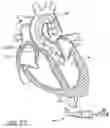 Fig. 94 - Method of Treating a Patient Using a Retrievable Transcatheter Prosthetic Heart Valve