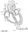Fig. 95 - Method of Treating a Patient Using a Retrievable Transcatheter Prosthetic Heart Valve