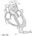 Fig. 96 - Method of Treating a Patient Using a Retrievable Transcatheter Prosthetic Heart Valve