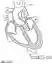 Fig. 98 - Method of Treating a Patient Using a Retrievable Transcatheter Prosthetic Heart Valve