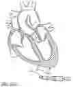 Fig. 99 - Method of Treating a Patient Using a Retrievable Transcatheter Prosthetic Heart Valve
