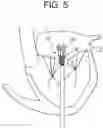 Fig. 05 - Truncated cone heart valve stent
