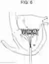 Fig. 06 - Truncated cone heart valve stent